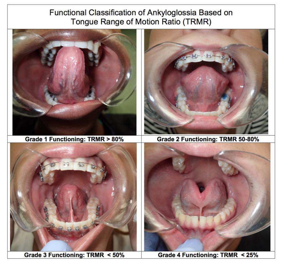 Comprehensive Guide to Finding the Right Texas Tongue Tie Doctor